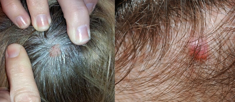 Moles on Scalp Pictures